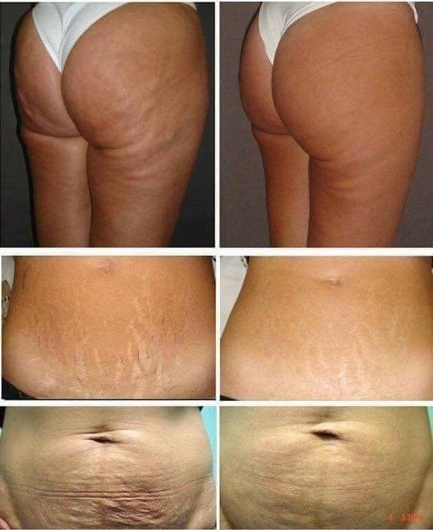 Reader submissions — cellulite, stretch marks, and post-pregnancy firmness transformations
